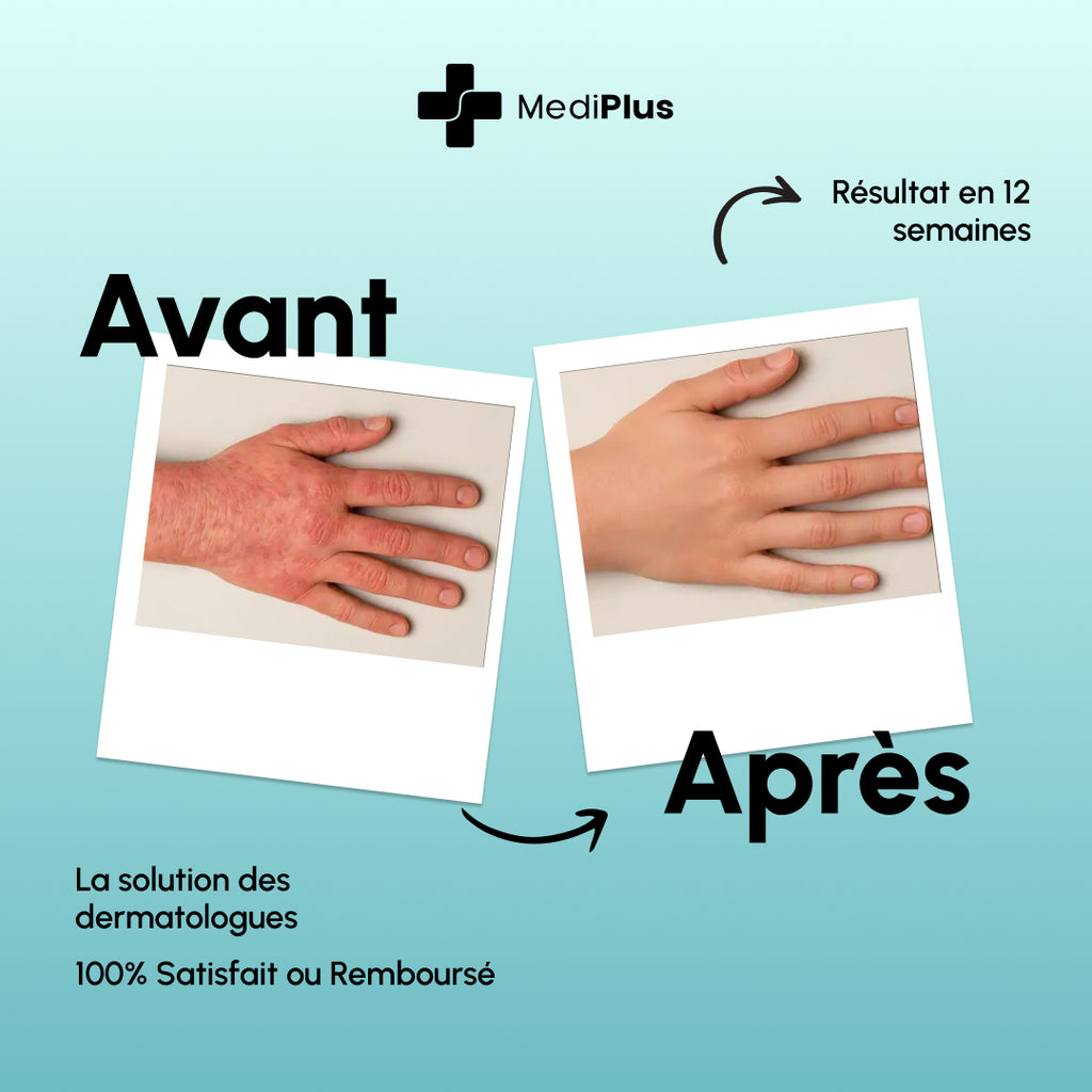 Eczaderm — Solution contre l'eczema