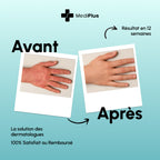 Eczaderm — Solution contre l'eczema