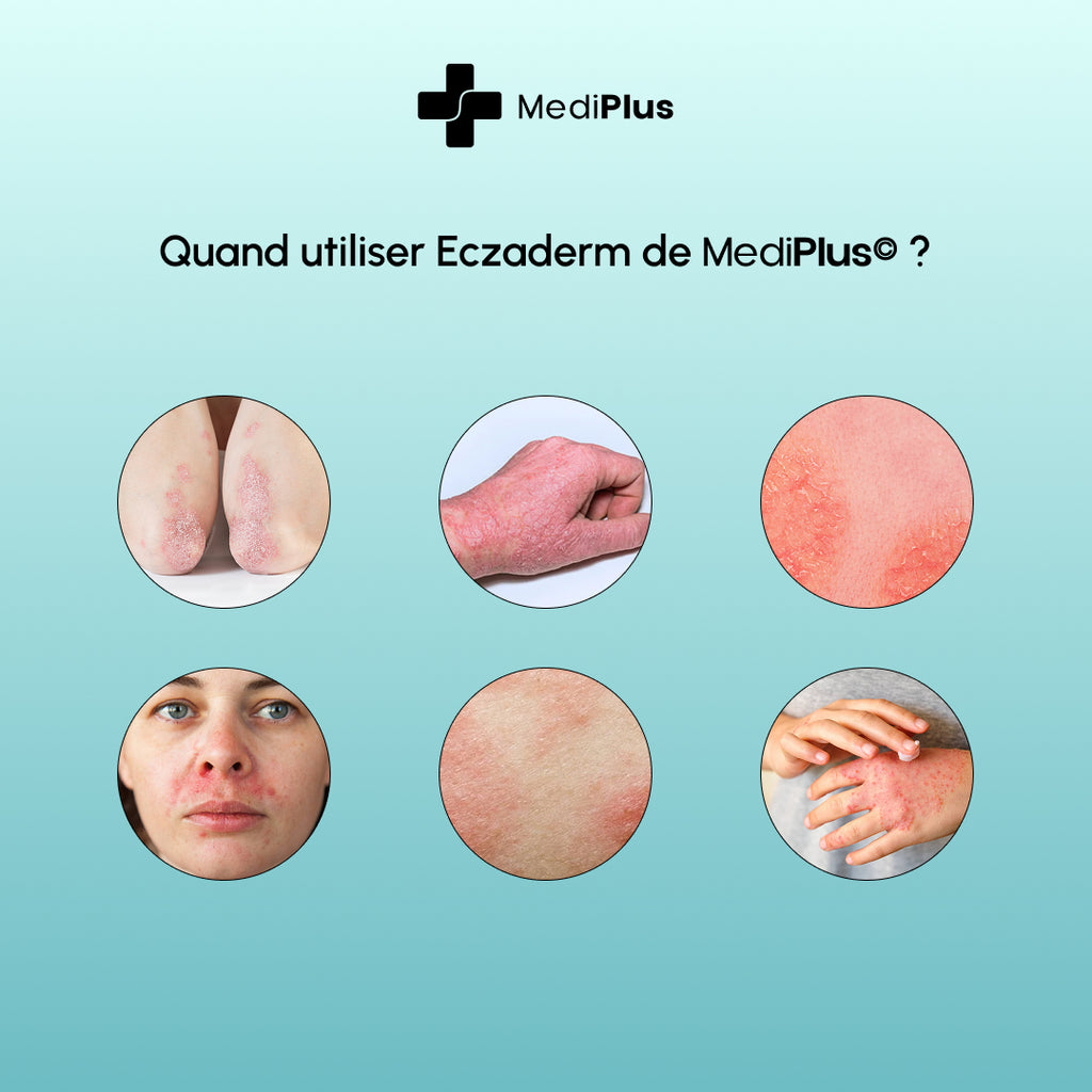 Eczaderm — Solution contre l'eczema