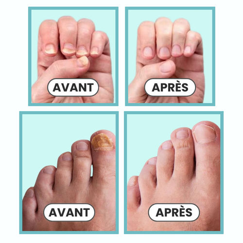 Appareil Anti-Mycose MediPlus©