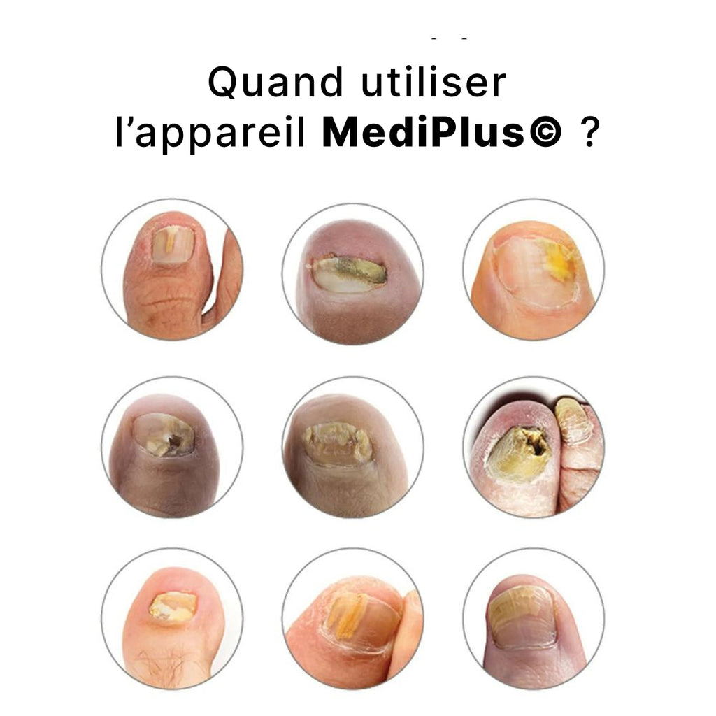 Appareil Anti-Mycose MediPlus©